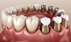 découvrez notre comparatif détaillé entre la céramique capdentaire et les autres matériaux utilisés pour les couronnes et facettes, afin de choisir la meilleure option pour votre sourire.